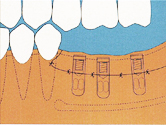 implantat 03